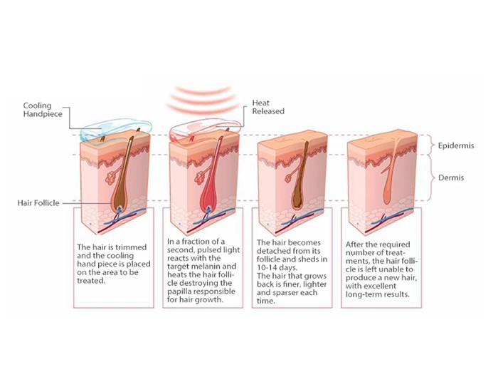 laser hair removal and skin rejuvenation machine
