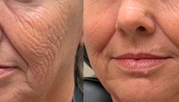 Terini lazer bilan qayta tiklashning o'rtacha narxi qancha