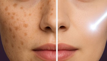 Lazerdan keyin pigmentatsiya qancha vaqt o'tadi