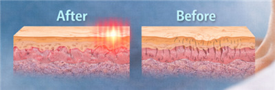 Terini lazer bilan taranglash doimiymi