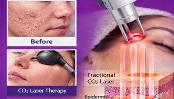 CO2 lazer akne chandiqlaridan xalos bo'lishi mumkinmi?