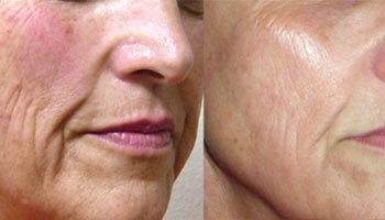 Qarigan teri uchun eng samarali lazer nima?