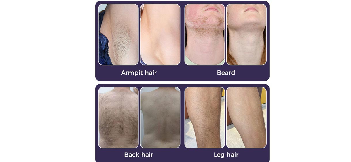 laser hair removal and skin rejuvenation machine laser hair removal and skin rejuvenation machine